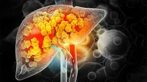 Fatty Liver Disease: A Silent Epidemic Gripping India